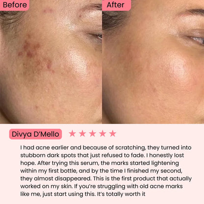 Anua Niacinamide 10% + Txa 4% for Brightening and Dark Spots